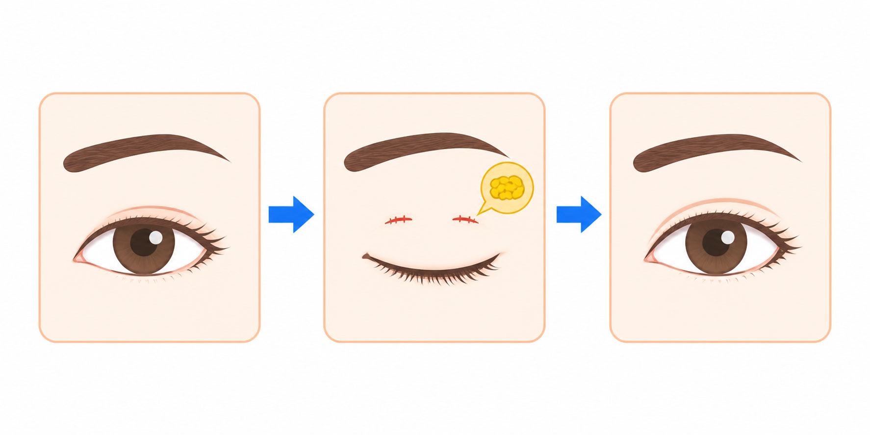 小切開法の説明用イラスト