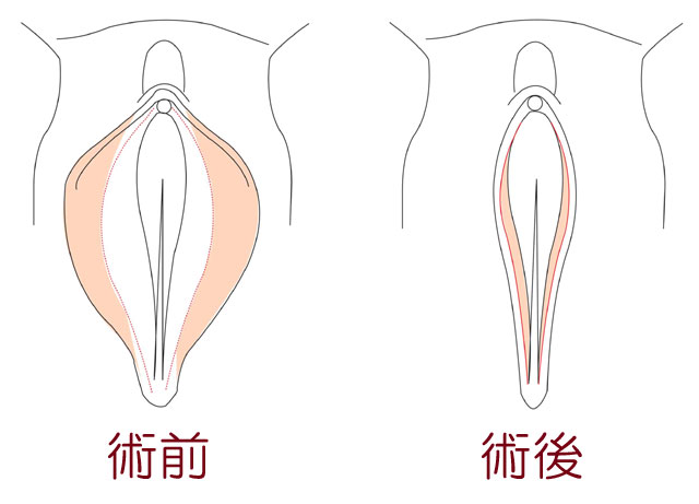 小陰唇縮小術の切除範囲を示す模式図